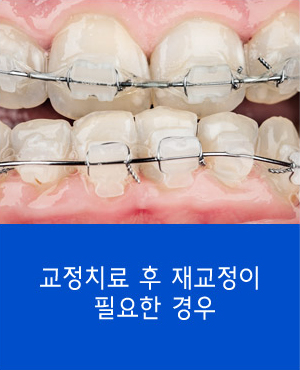 자가 치아 뼈이식재