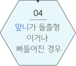 돌출입이면서 사각턱이신분