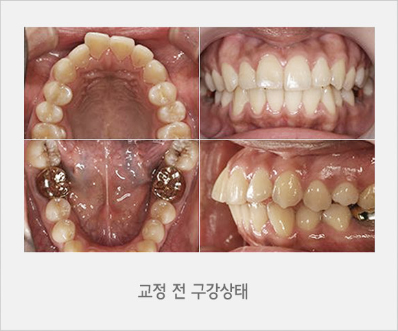 교정 전 구강상태