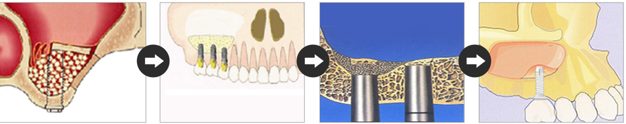 상악동 뼈이식 임플란트