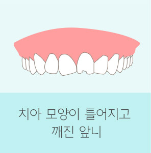 자가 치아 뼈이식재