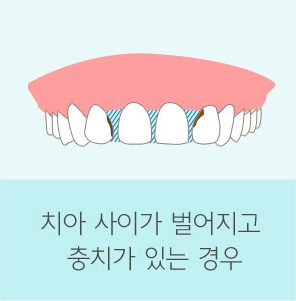 자가 치아 뼈이식재