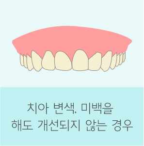 자가 치아 뼈이식재