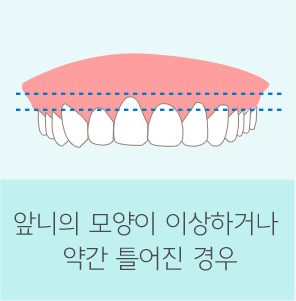 자가 치아 뼈이식재