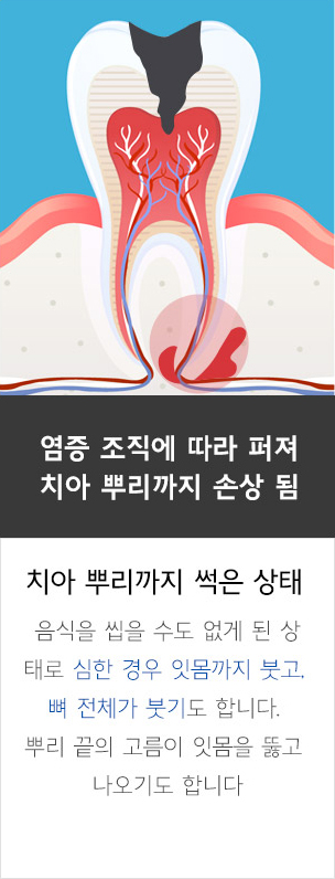 자가 치아 뼈이식재