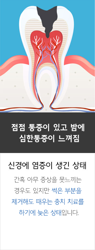 자가 치아 뼈이식재